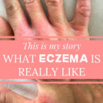 This is my story – What eczema is really like