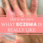 This is my story – What eczema is really like